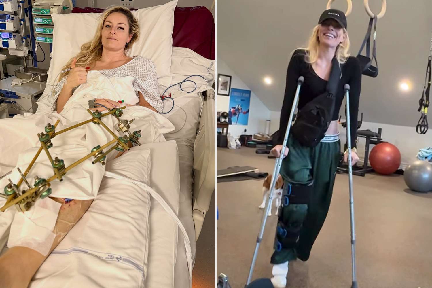 Lindsey Vonn Reveals Her Sister Also Tore Her ACL: 'Welcome to the Vonn Rehab Center'