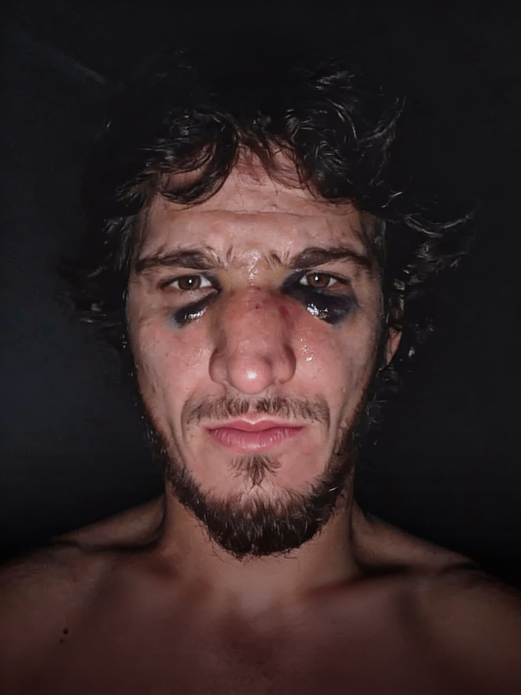 Pic: Movsar Evloev broke his nose four weeks before UFC main event