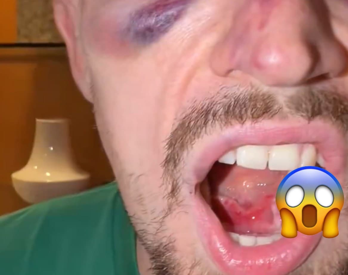New Headline: "Ripper of MMA" Raul Diaz Swallows a Tooth-Fixing Nightmare