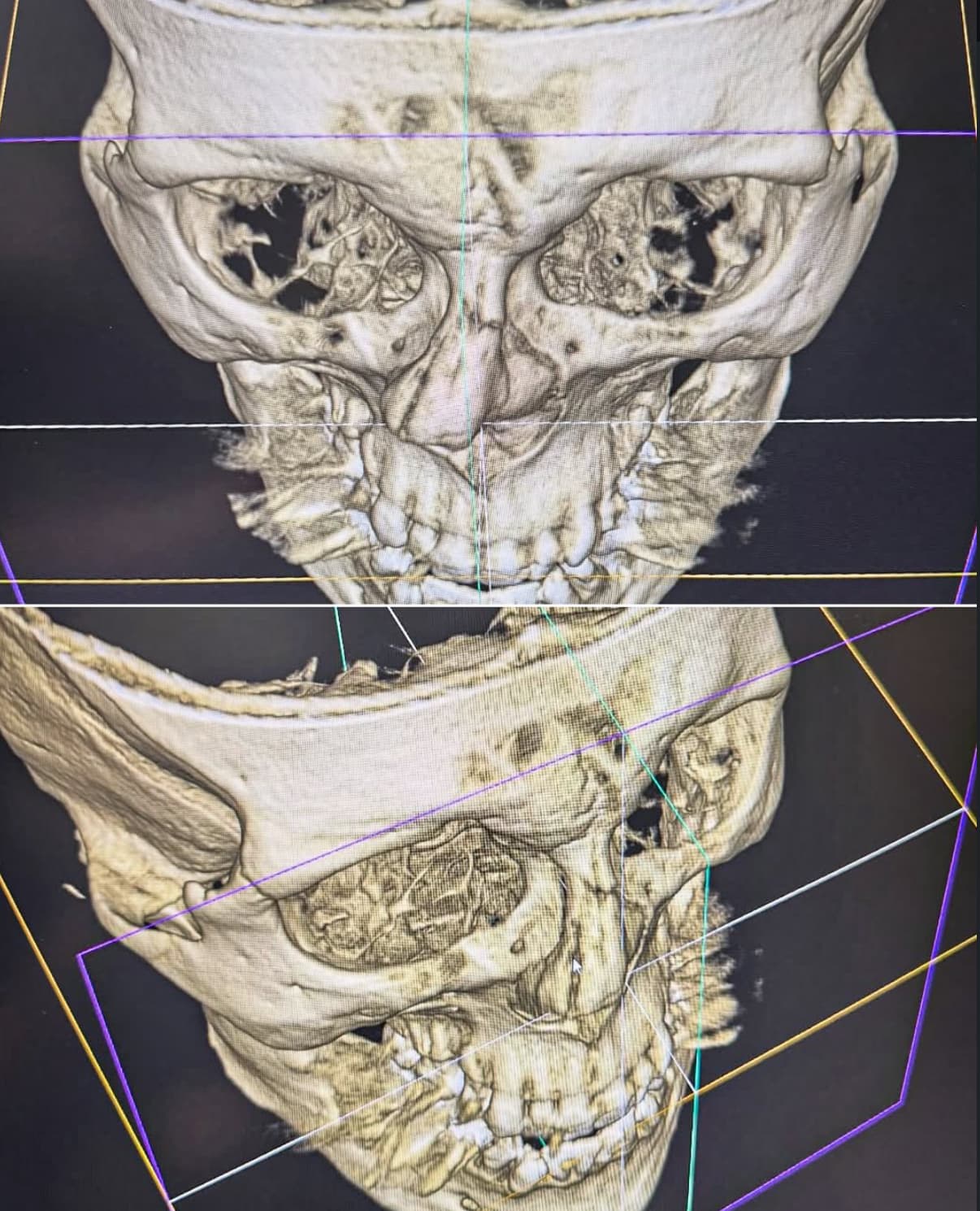 Merab Shatters Nose (Again), Refuses Surgery